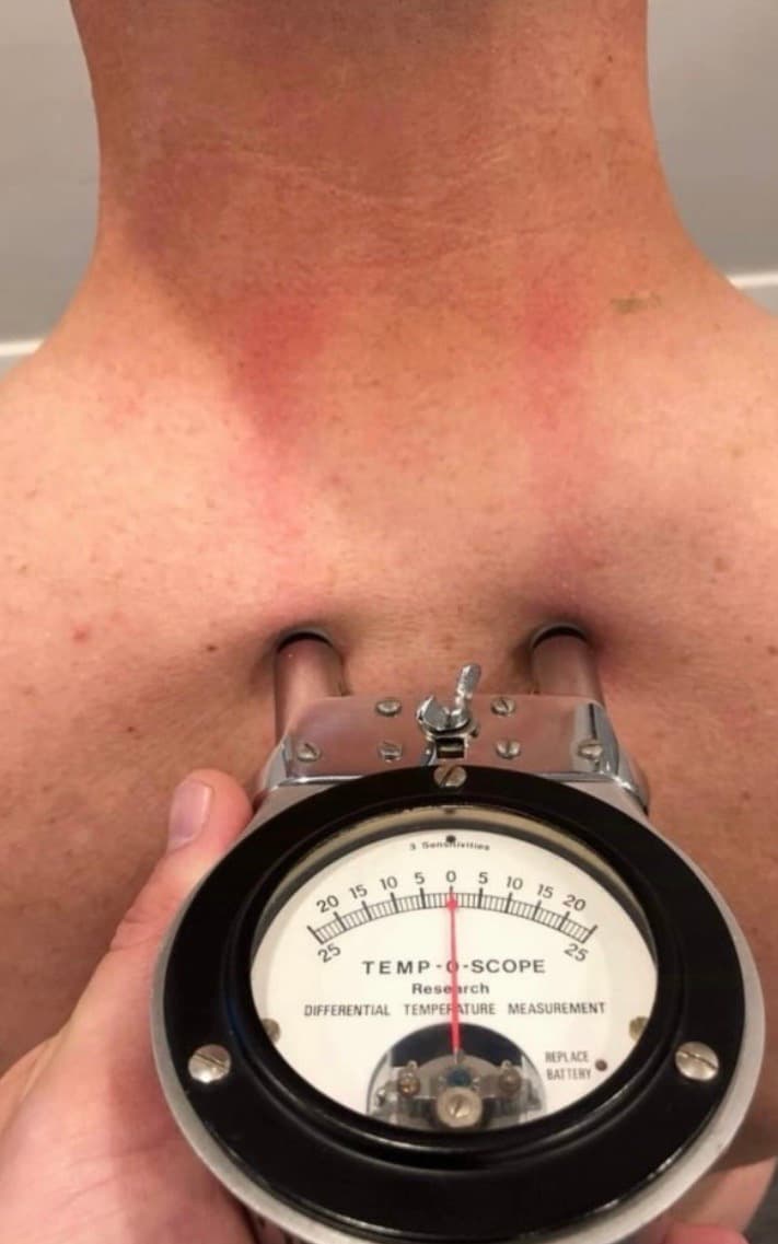 A dual-probe nervoscope being drawn down a patient's spine
